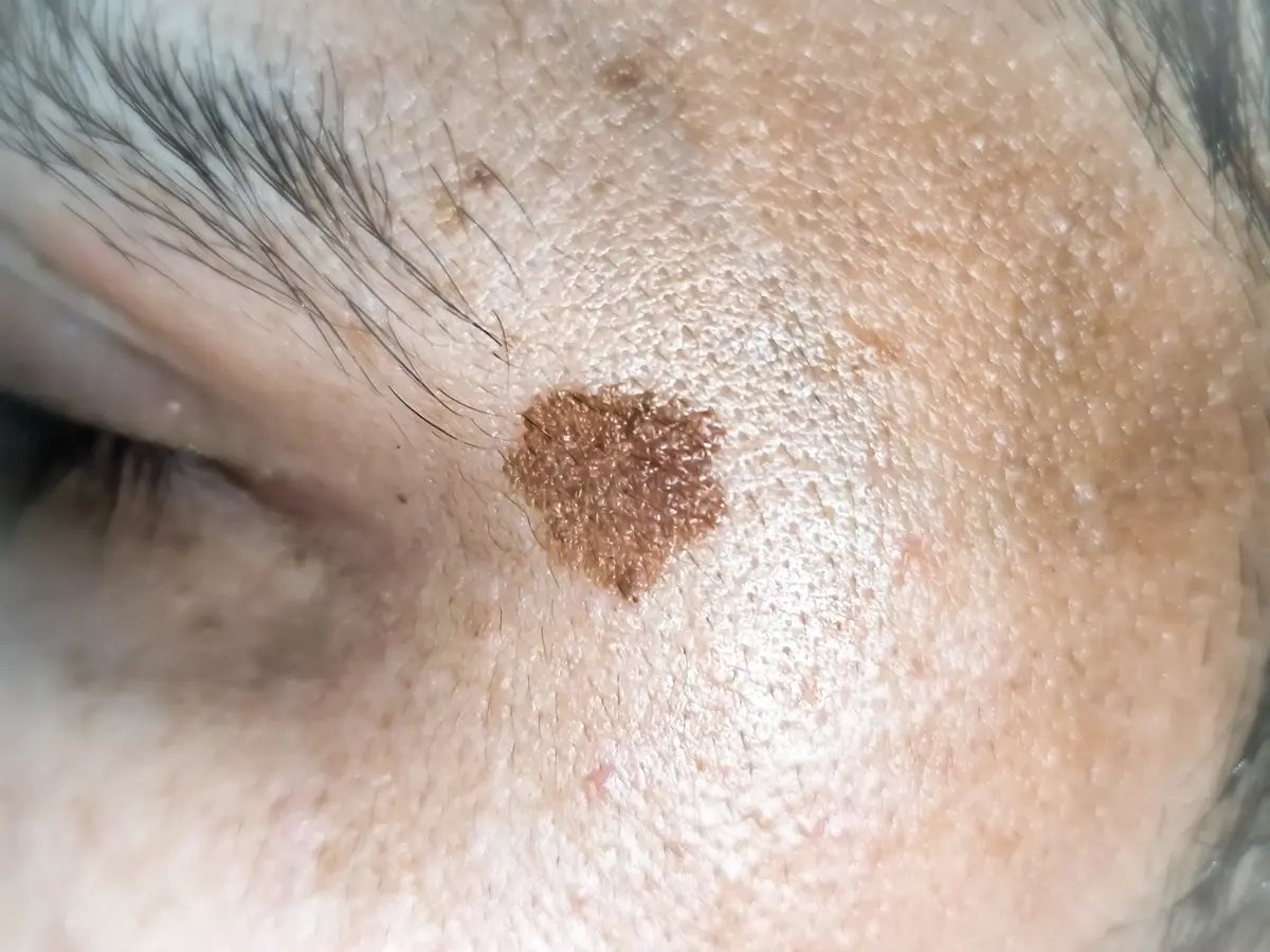Close view of a sun spot on skin
