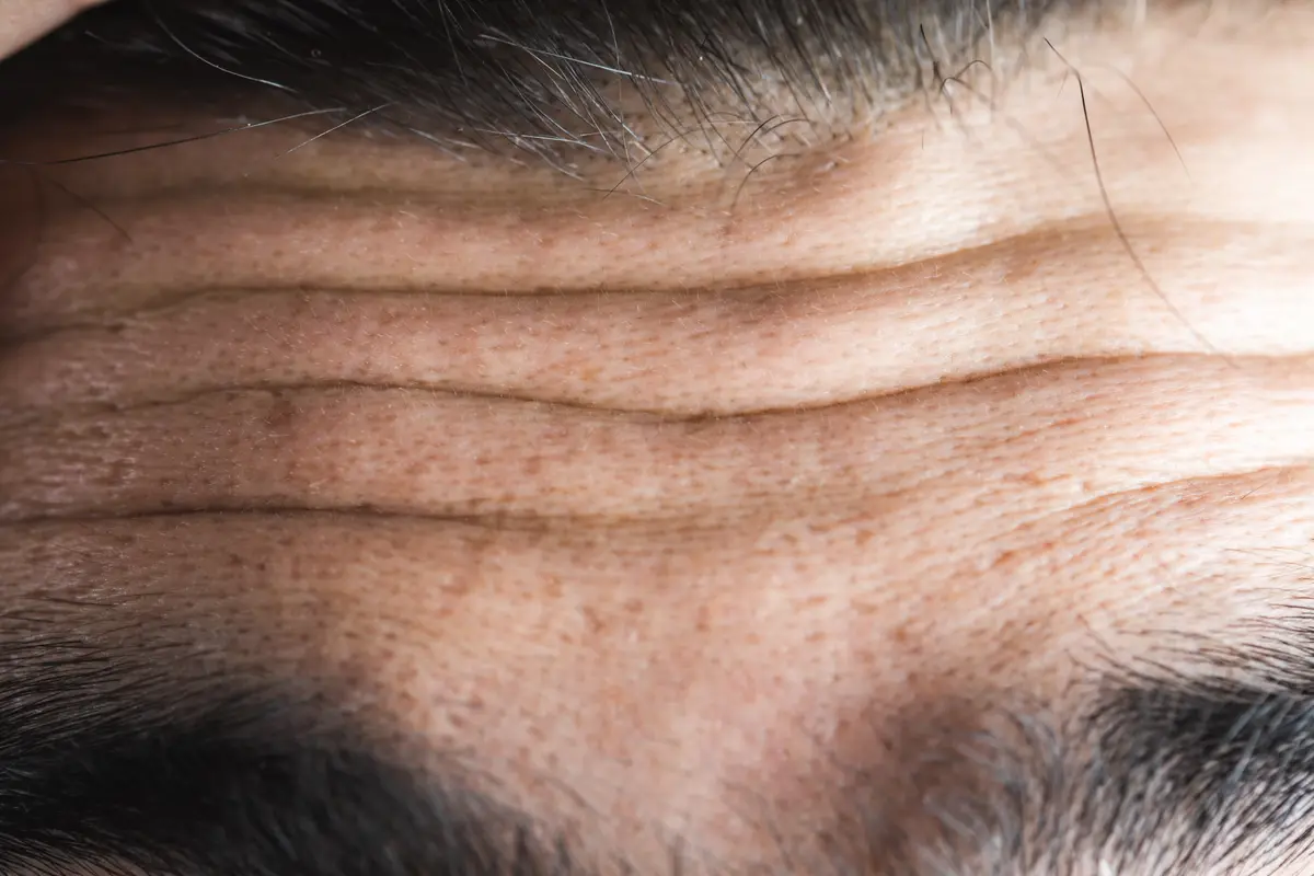 Close view of deep forehead wrinkles