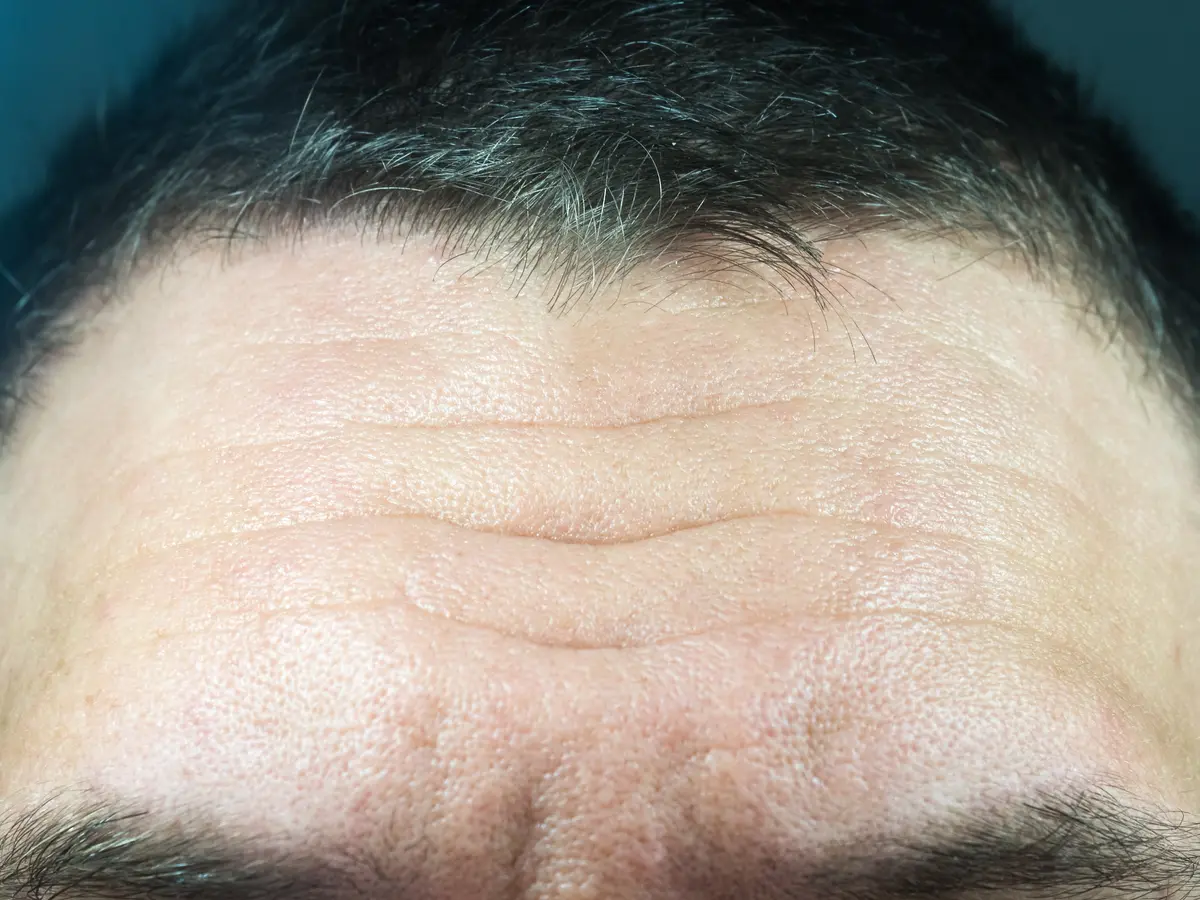 Close view of forehead lines on a man
